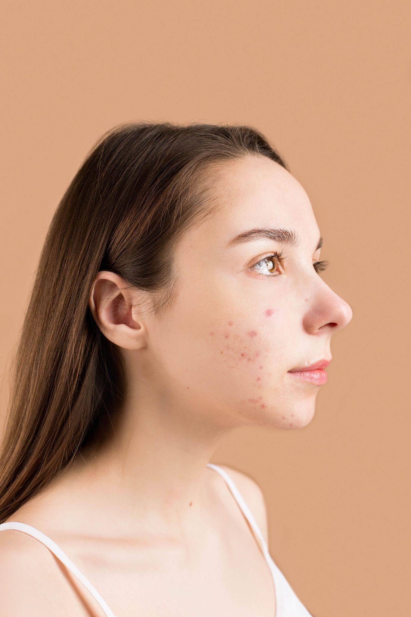 Jeune femme à la peau sujette aux imperfections, protection solaire et soin du visage à Villeneuve-Loubet